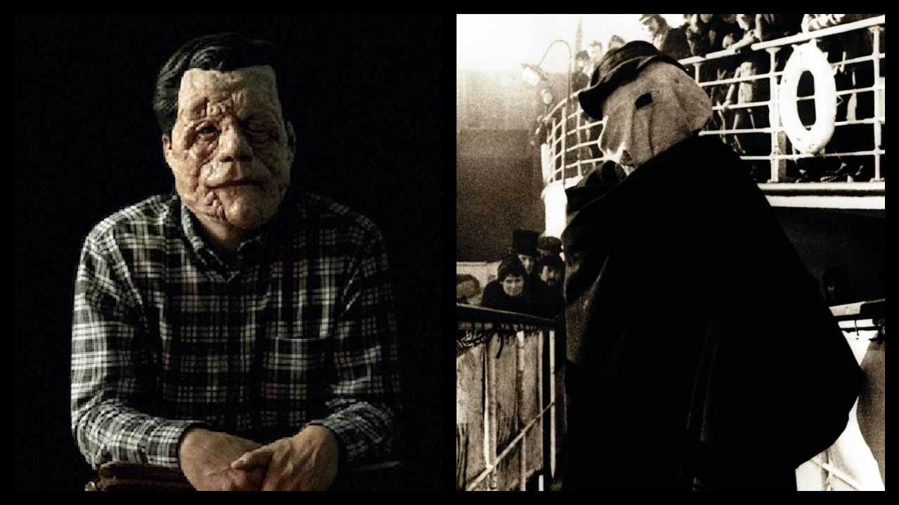 Adam Pearson Starring in ‘The Elephant Man’